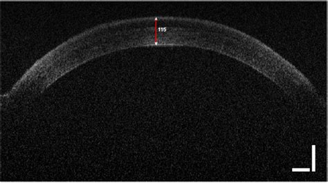 oct corneal thickness test